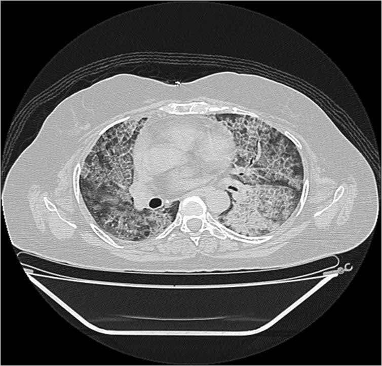 A 60-year-old lady suffering from a rare lung disorder ? Pulmonary alveolar proteinosis - has been treated successfully treated at KRIMS Hospital, Nagpur.