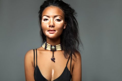 Read what dermatologist from Nagpur Dr Tulika Arbat has to say about skin condition 'Vitiligo,' its side effects and more.